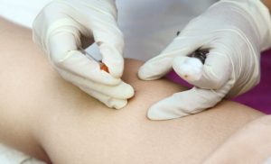 Lợi ích của phương pháp cấy chỉ