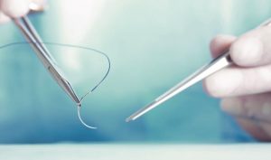 Lưu ý khi thực hiện cấy chỉ