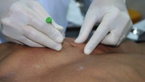 Phương pháp cấy chỉ là gì