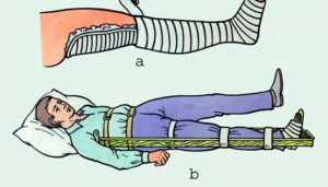 Cách sơ cứu gãy xương chân