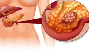 các nguyên nhân gây ung thư tụy