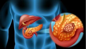 các loại ung thư tụy thường gặp