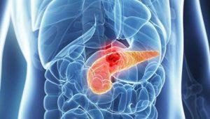 ung thư tụy là gì