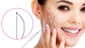 Chỉ collagen Simple Catgut